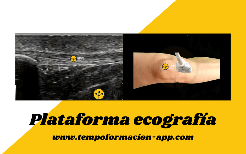 2. Tendon rotuliano ecografia tempo formacion.png